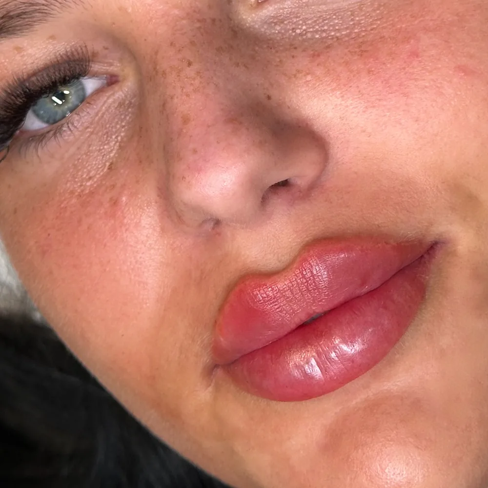 Fresh lip enhancement immediately after treatment, close-up view