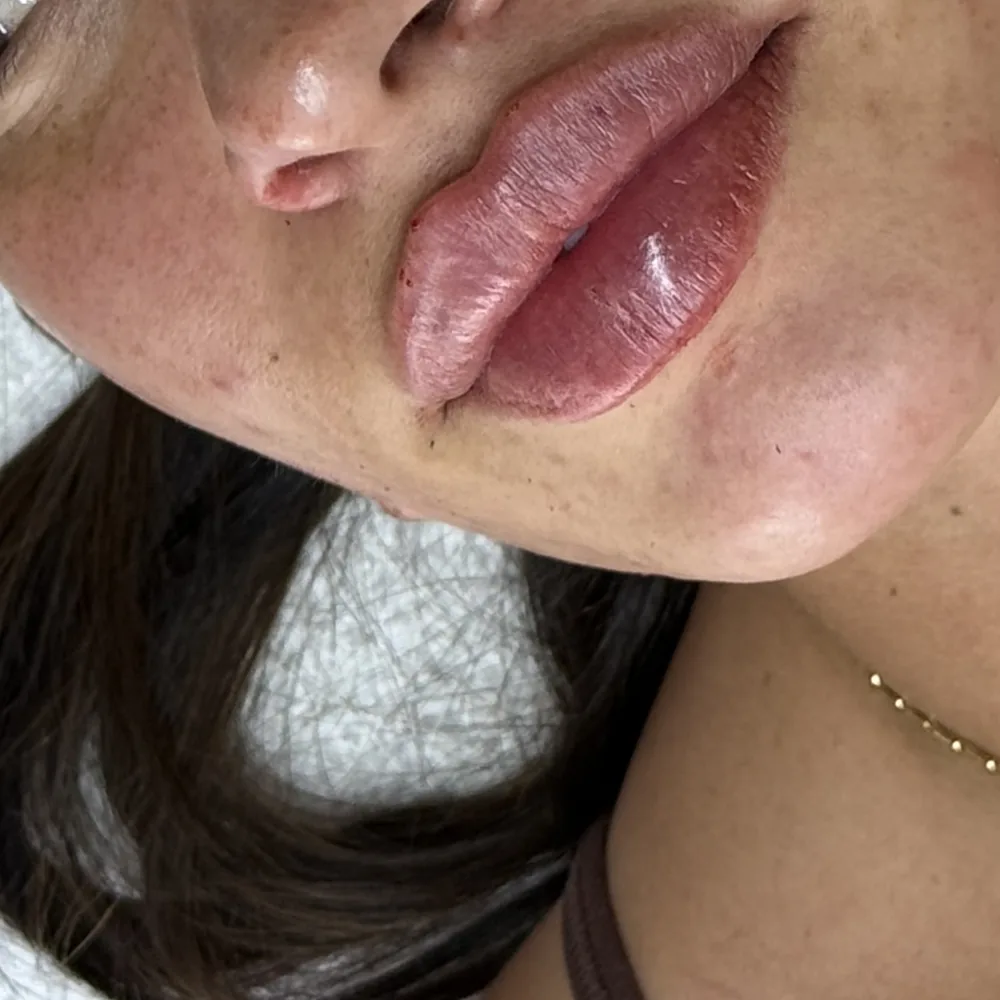 Fresh lip enhancement immediately after treatment, alternate close-up view