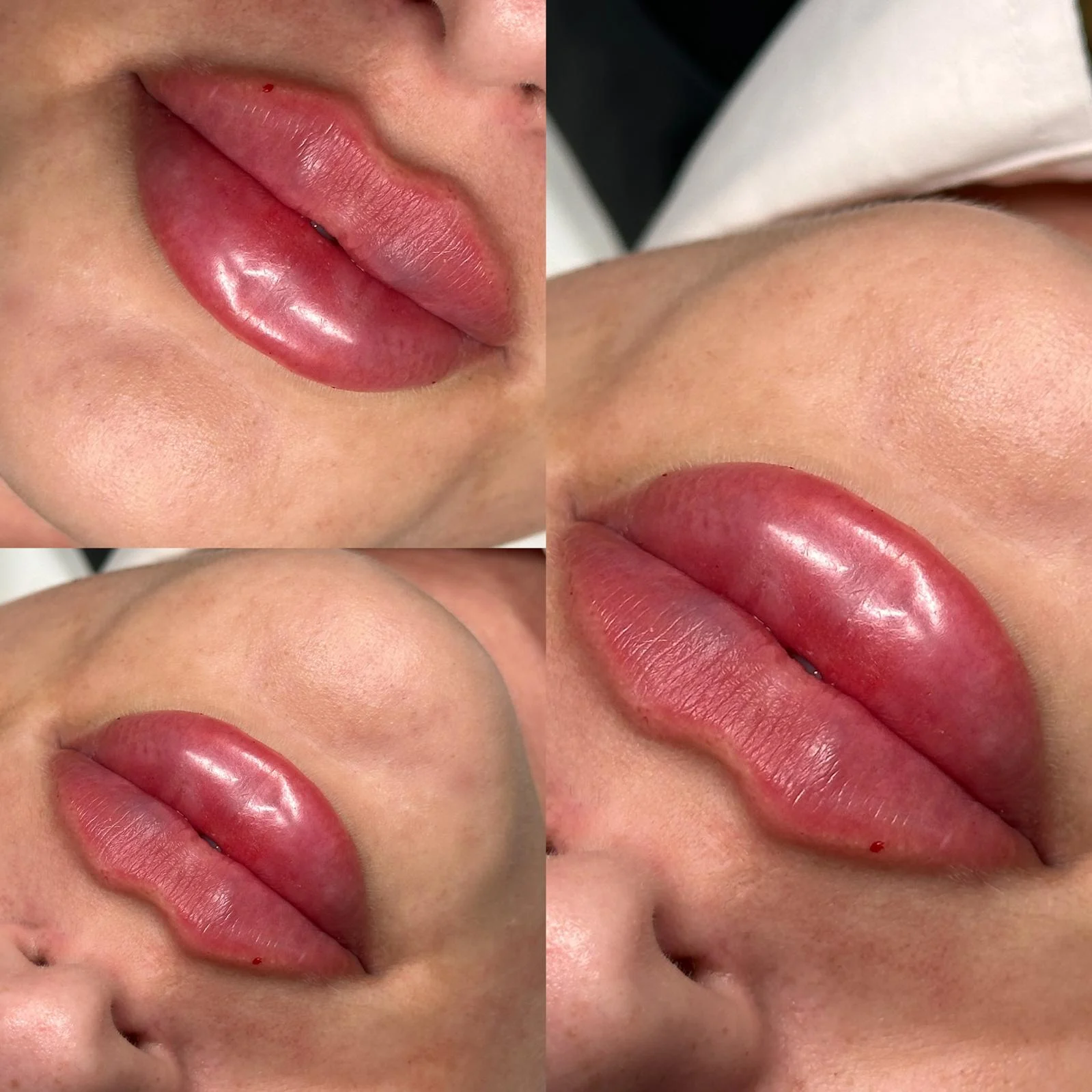 Three views of fresh lip enhancement immediately after treatment