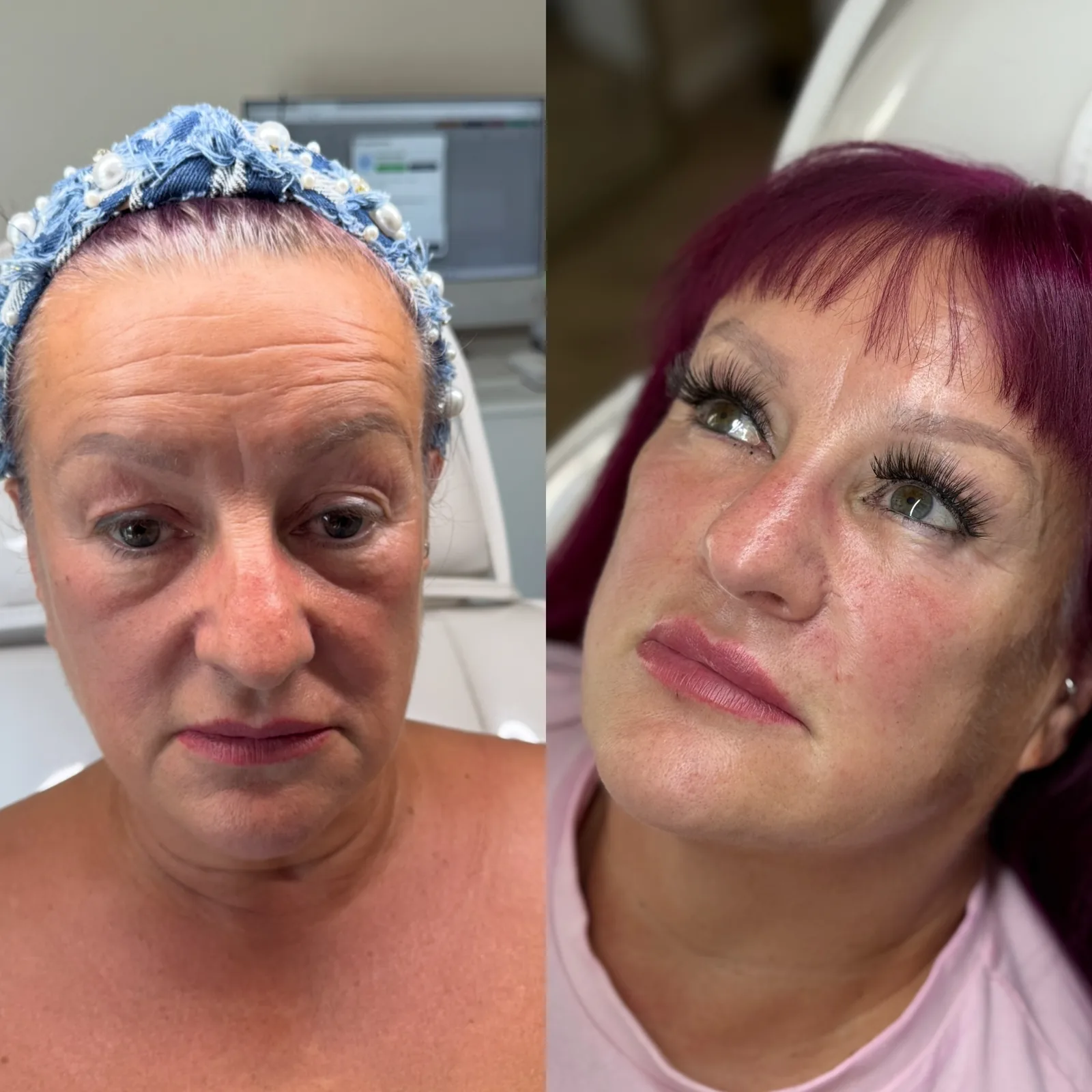 Before and after facial aesthetics result