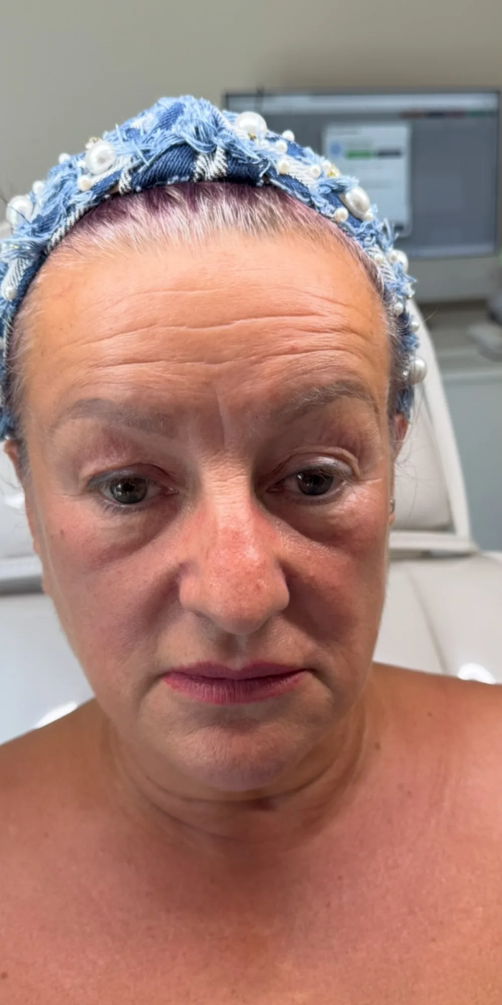 Before before and after facial aesthetics result