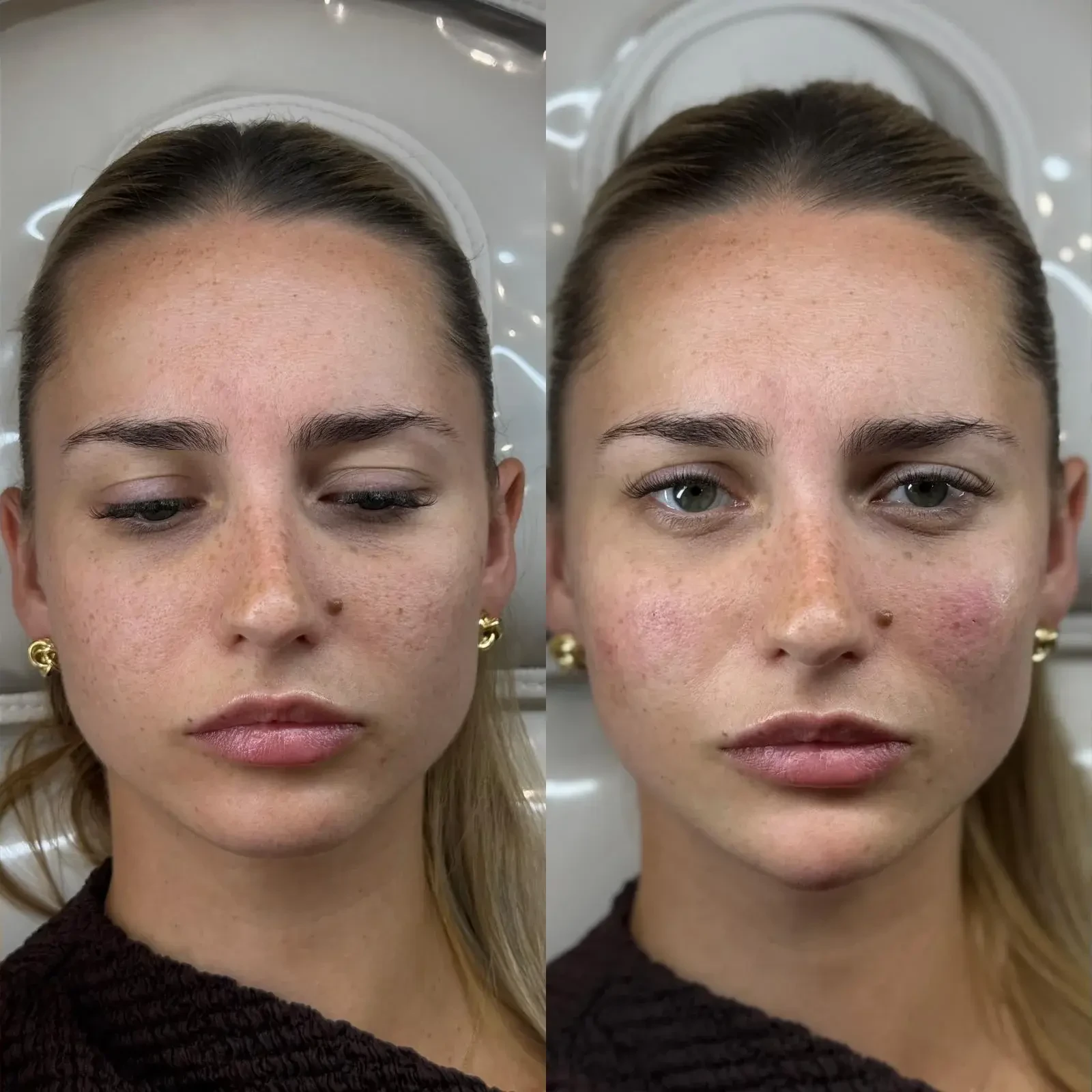 Before and after facial aesthetics result for a client with freckles