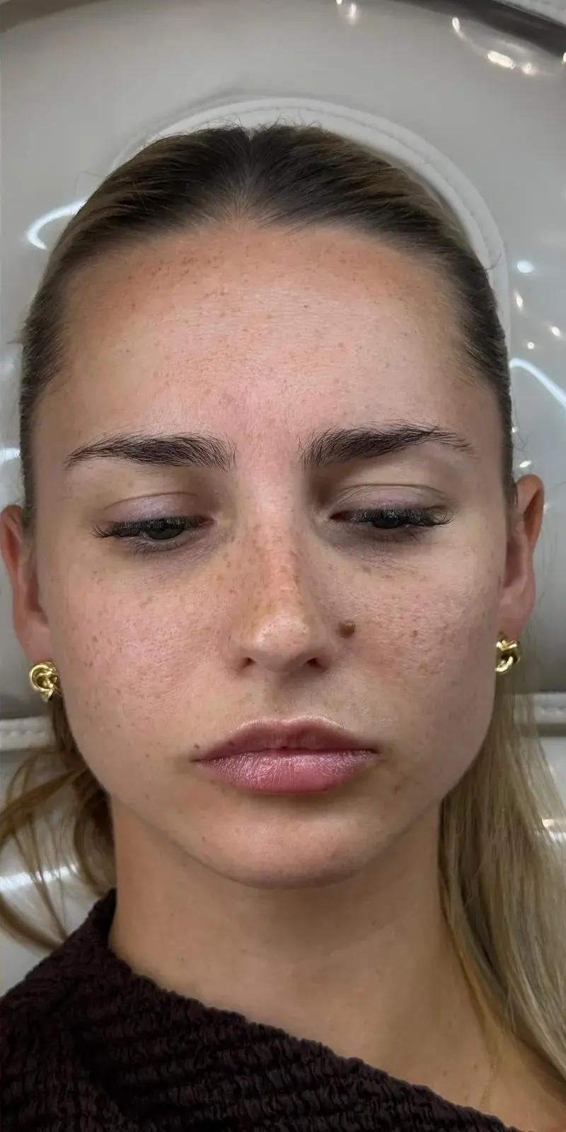 Before before and after facial aesthetics result for a client with freckles