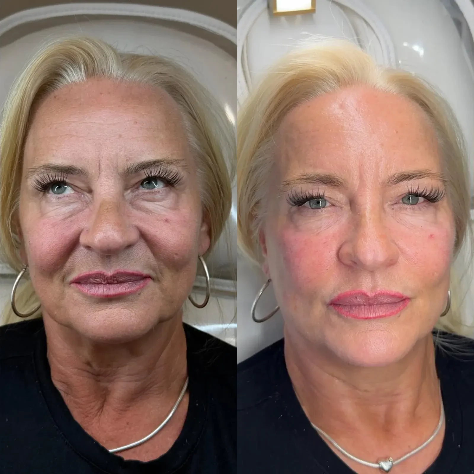 Before and after facial aesthetics result for a mature blonde client
