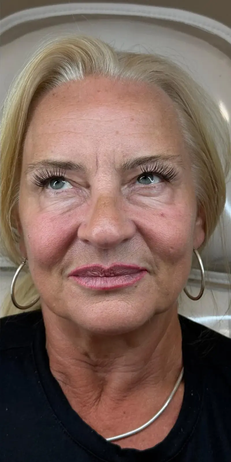 Before before and after facial aesthetics result for a mature blonde client