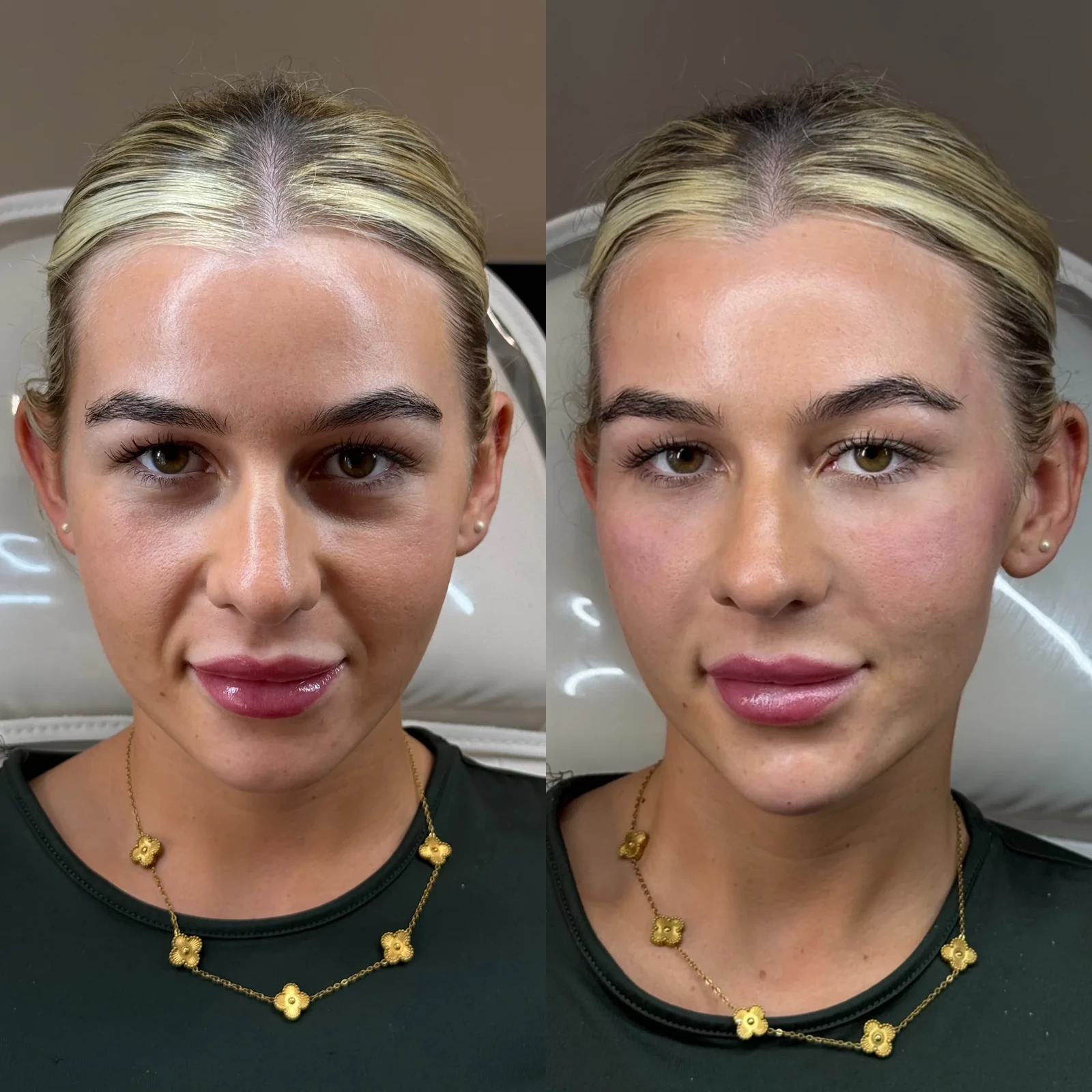 Before and after facial dermal filler result