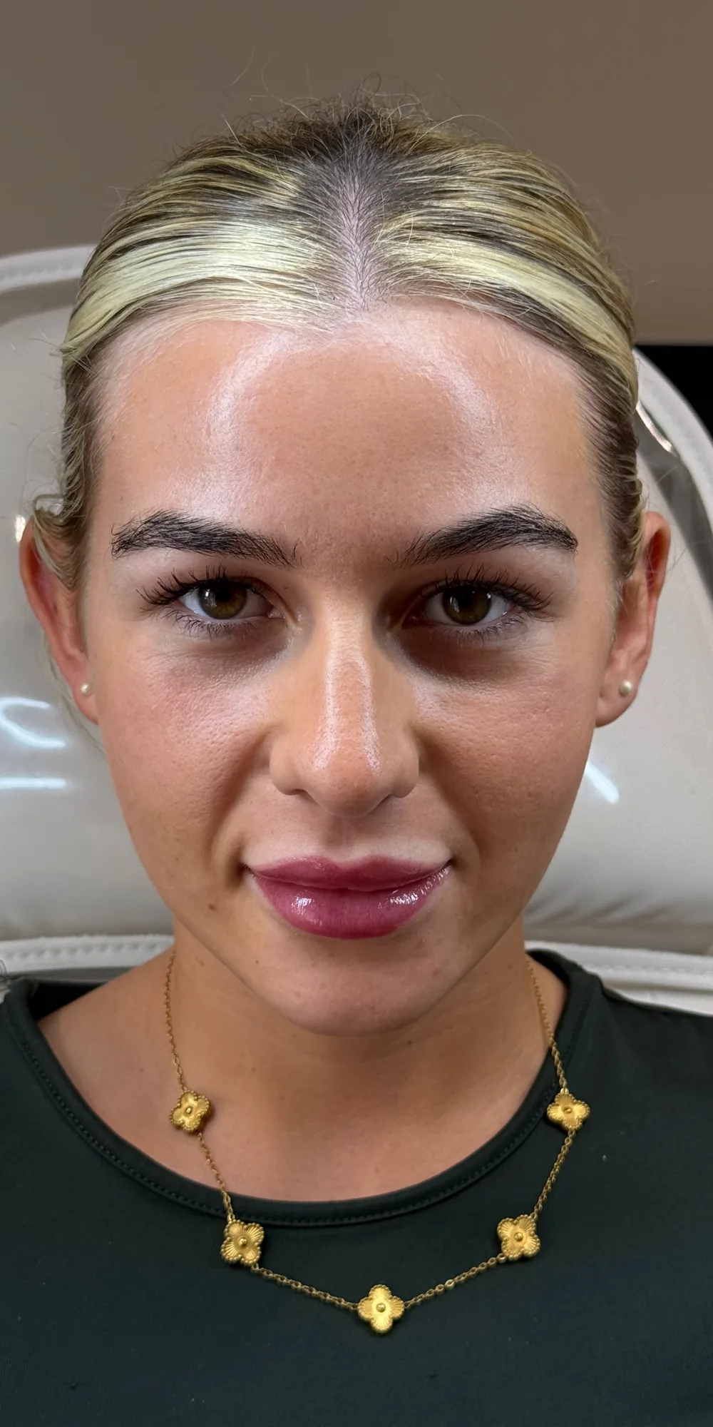 Before before and after facial dermal filler result