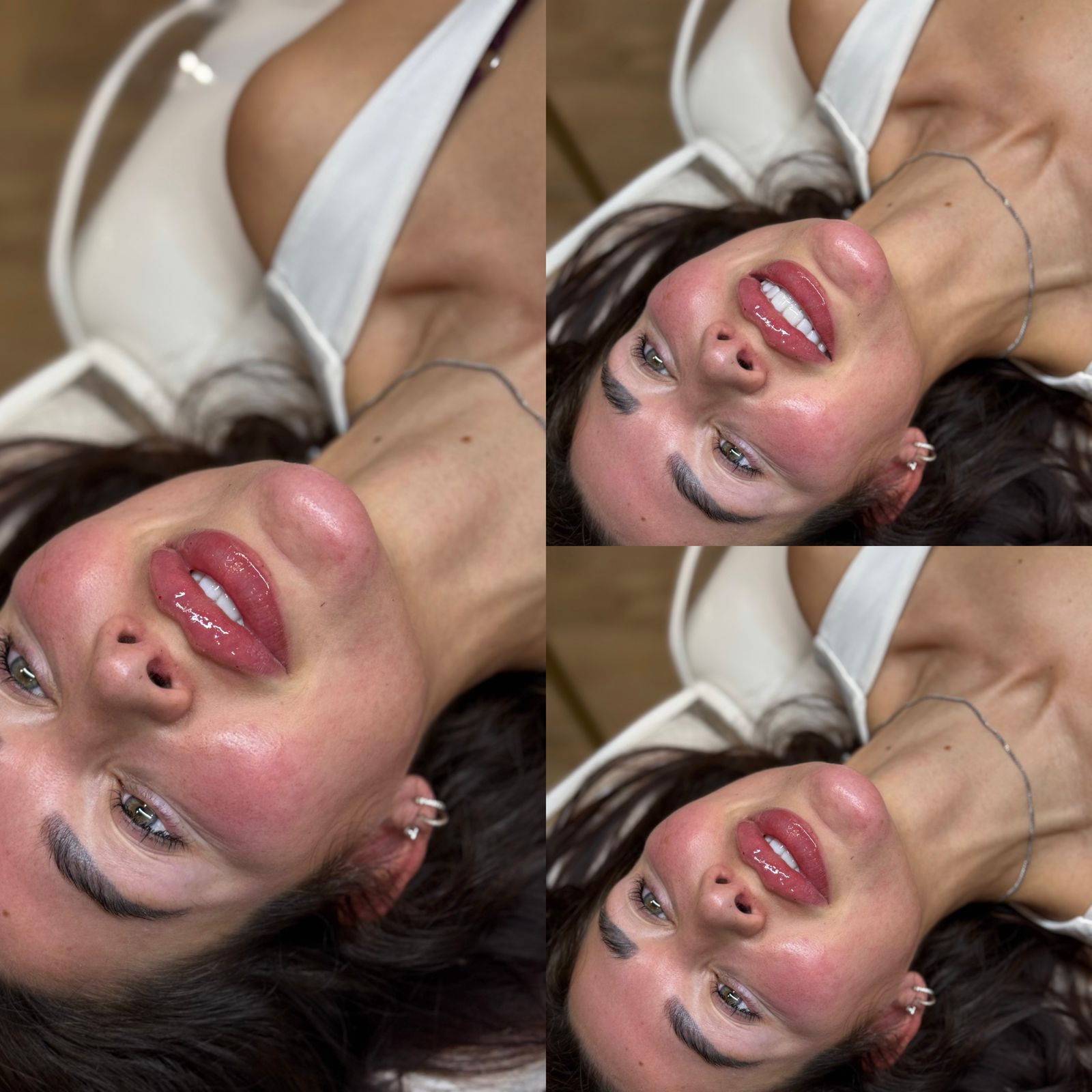 Russian lip filler before-and-after result, supplied as a multi-view image of the same client