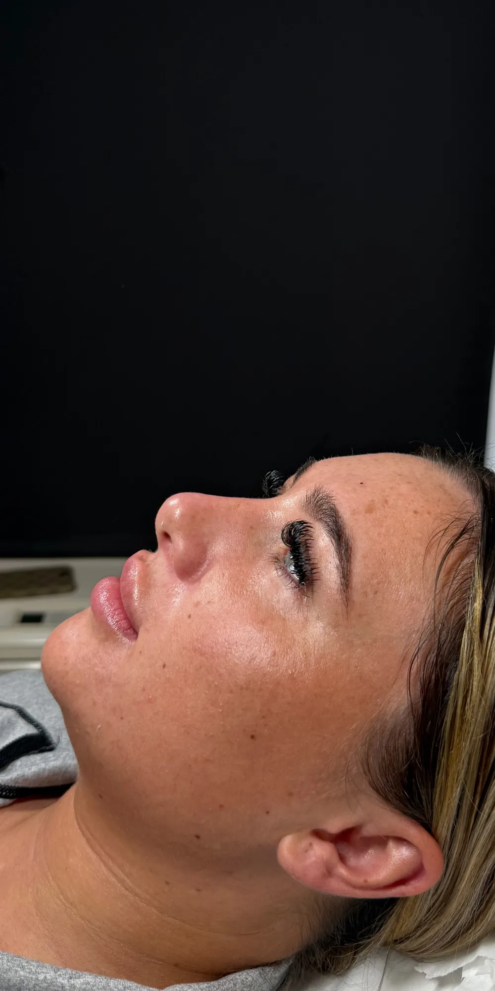 Before before and after side profile treatment result