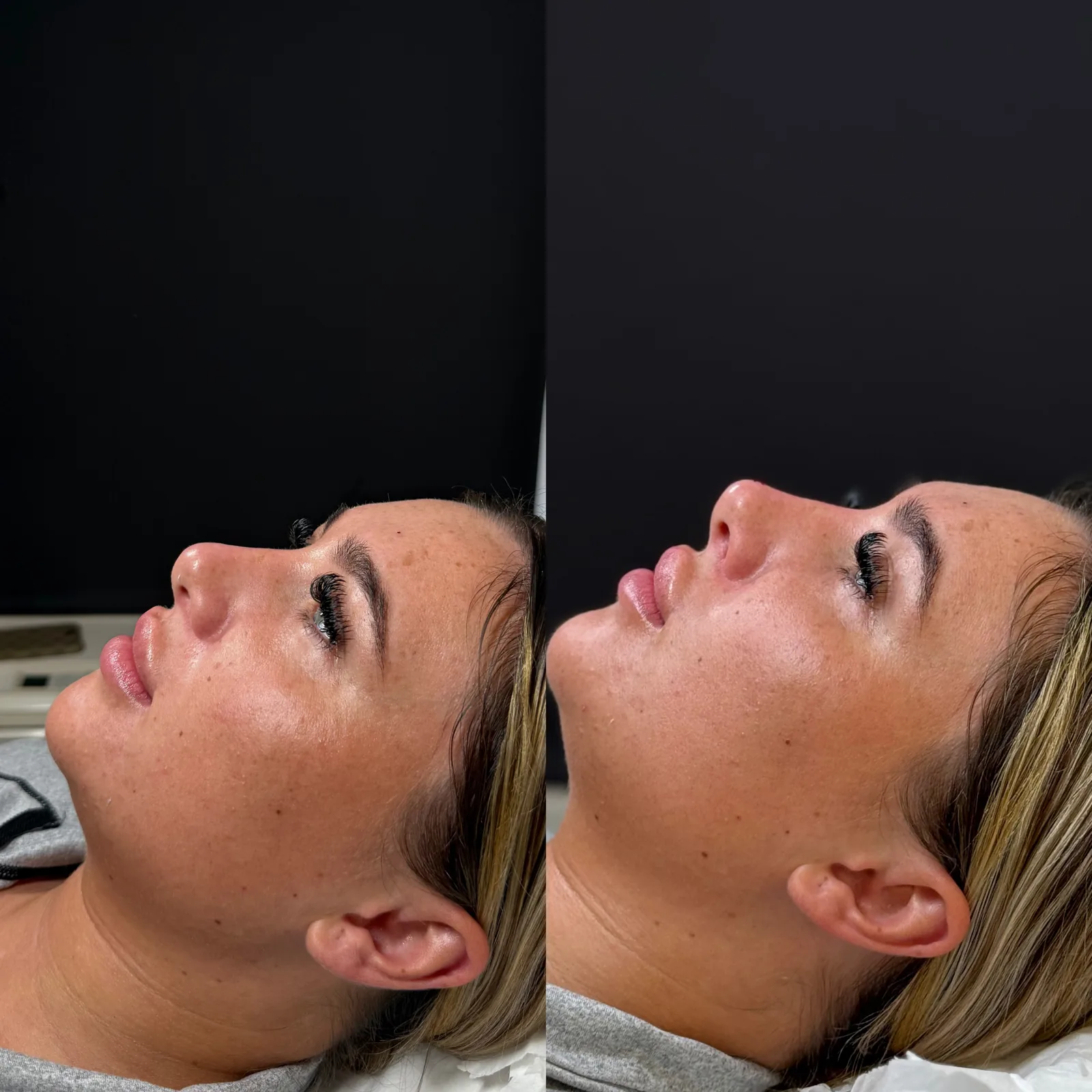 Before and after side profile treatment result